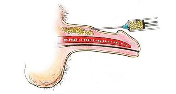 Injection of hyaluronic acid into a member's barrel to increase it